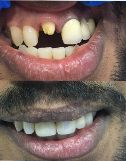 Before and after: Front tooth restoration at Dentcraft