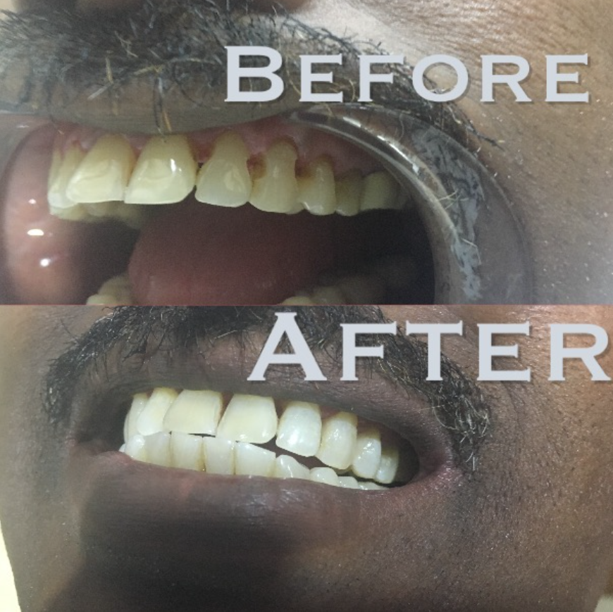 Before and after: Teeth whitening at Dentcraft